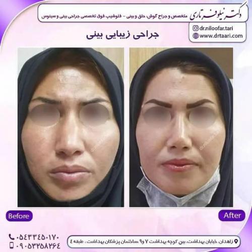 جراحی-بینی-زاهدان141
