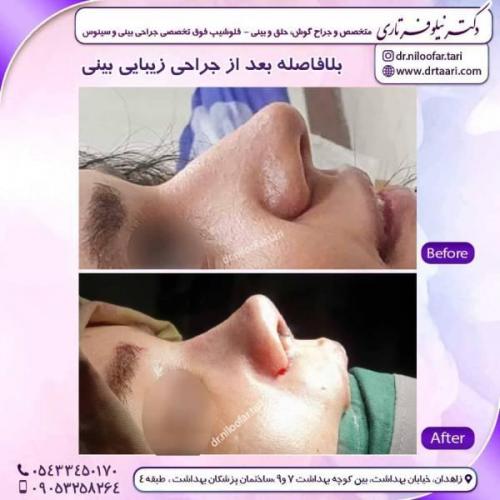 جراحی-بینی-زاهدان142