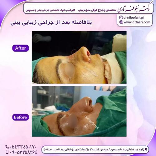 جراحی-بینی257 (1)