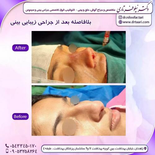 جراحی-بینی260