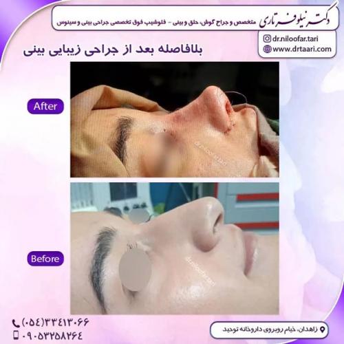 جراحی-بینی268 (1)