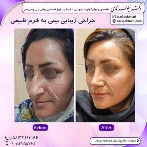 جراحی-بینی270 (1)