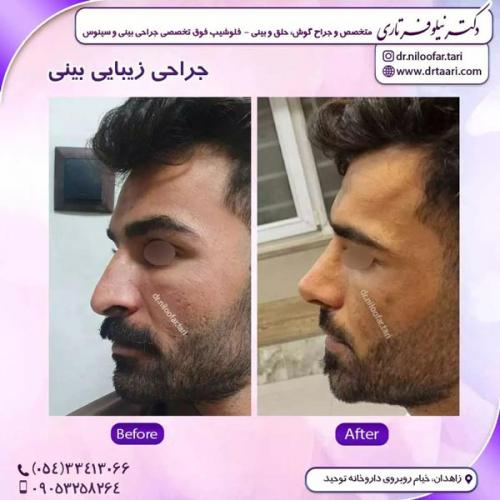 جراحی-بینی274