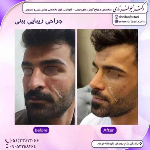 جراحی-بینی275