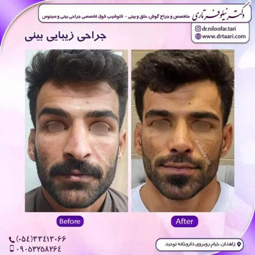 جراحی-بینی276