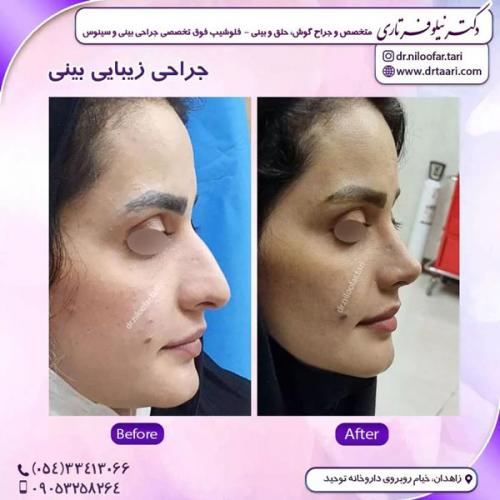 جراحی-بینی277