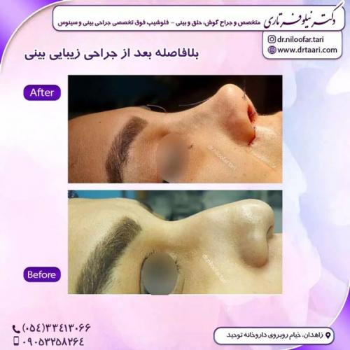 جراحی-بینی290