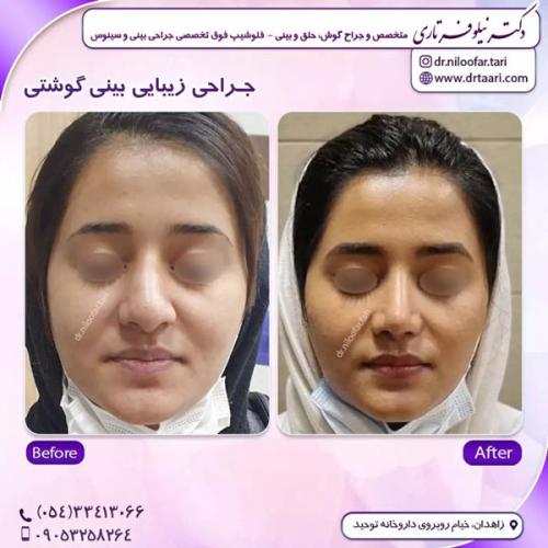 جراحی-بینی293