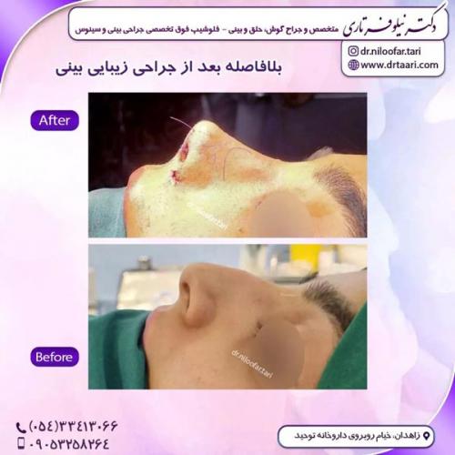 جراحی-بینی302