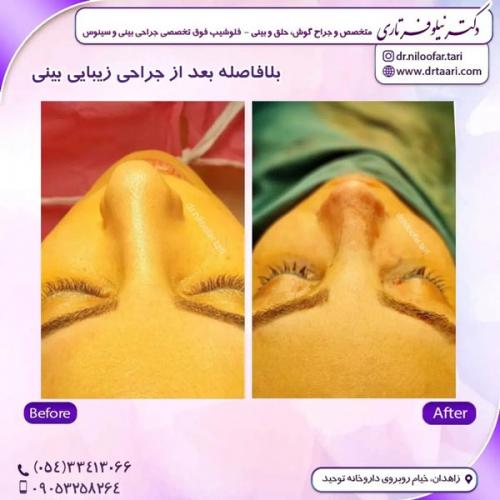 جراحی-بینی303