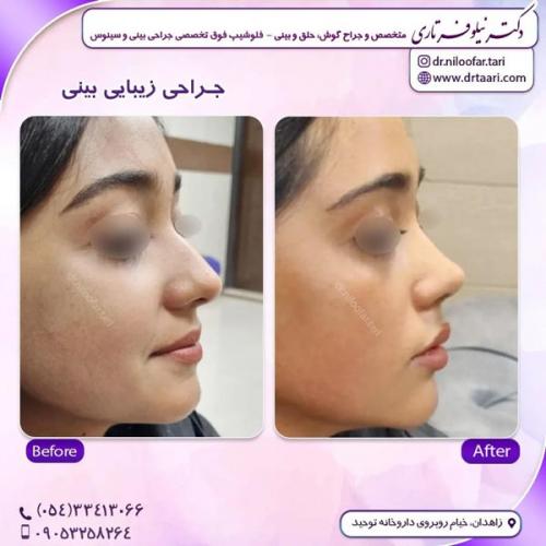 جراحی-بینی306
