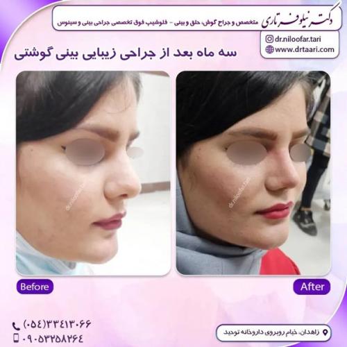جراحی-بینی310