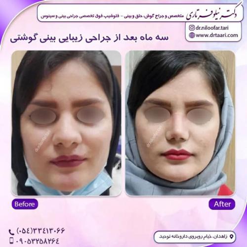 جراحی-بینی311