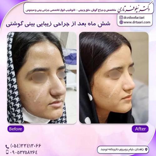 جراحی-بینی314