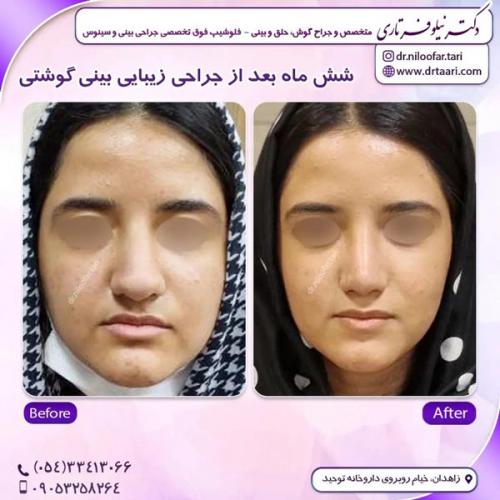 جراحی-بینی315