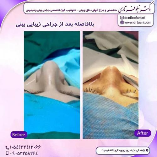 جراحی-بینی316