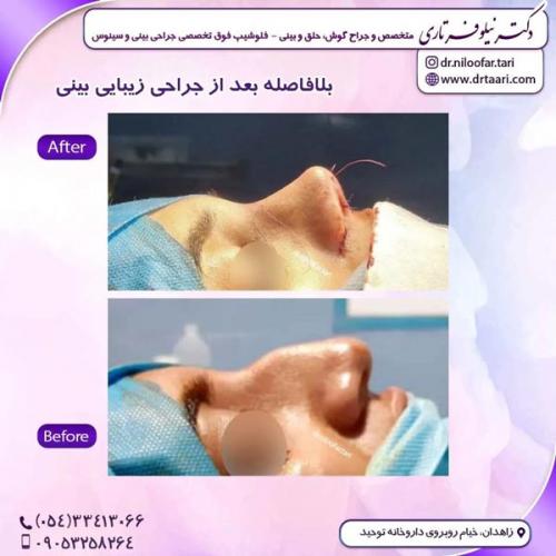 جراحی-بینی317