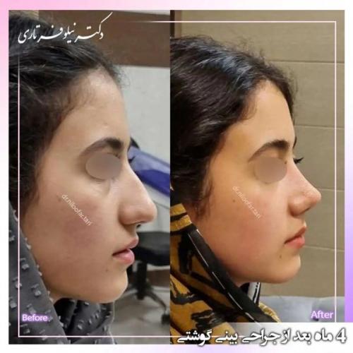 جراحی-بینی326