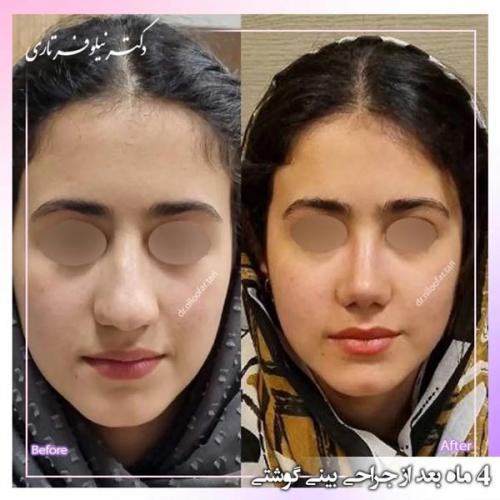 جراحی-بینی328