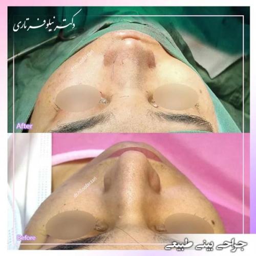 جراحی-بینی335