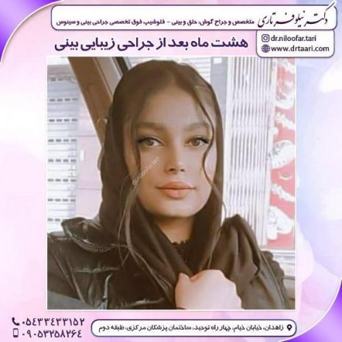 جراحی بینی 285 (11)