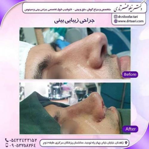 جراحی بینی 285 (13)