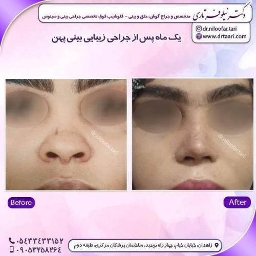 جراحی بینی 285 (14)
