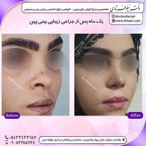 جراحی بینی 285 (15)