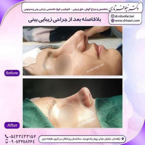 جراحی بینی 285 (16)