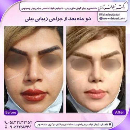 جراحی بینی 285 (17)