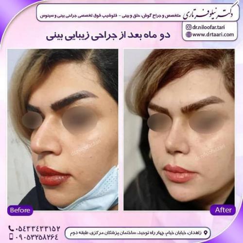 جراحی بینی 285 (18)