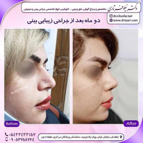 جراحی بینی 285 (19)