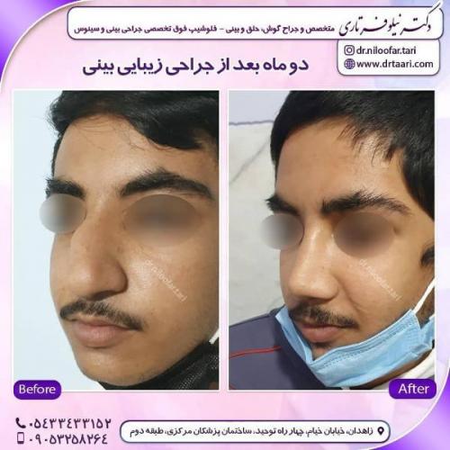 جراحی بینی 285 (2)