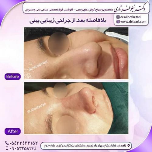 جراحی بینی 285 (22)