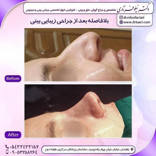 جراحی بینی 285 (23)
