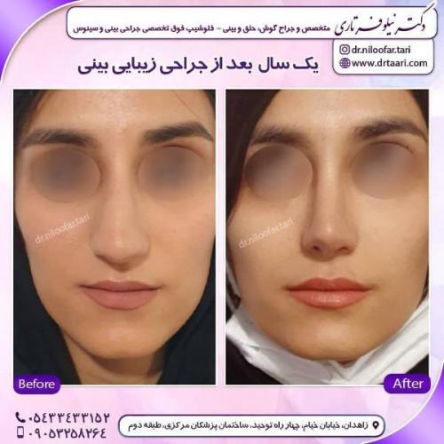 جراحی بینی 285 (24)