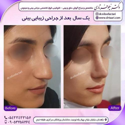 جراحی بینی 285 (25)