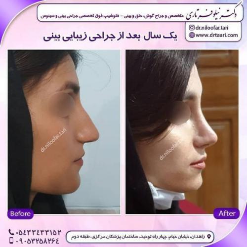 جراحی بینی 285 (26)