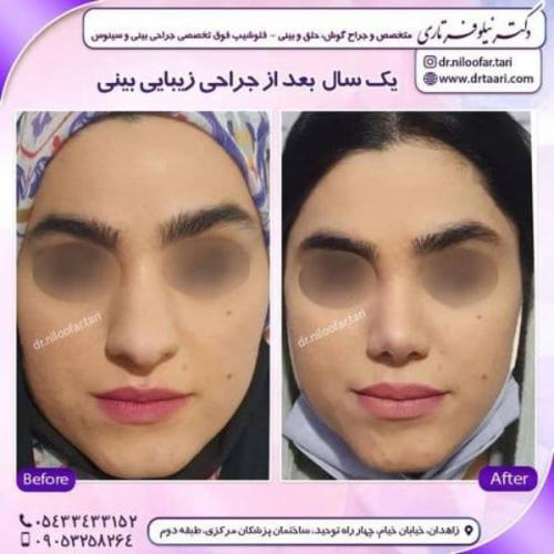 جراحی بینی 285 (27)