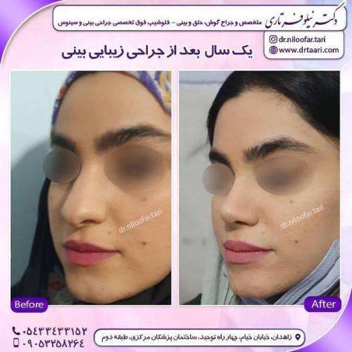 جراحی بینی 285 (28)