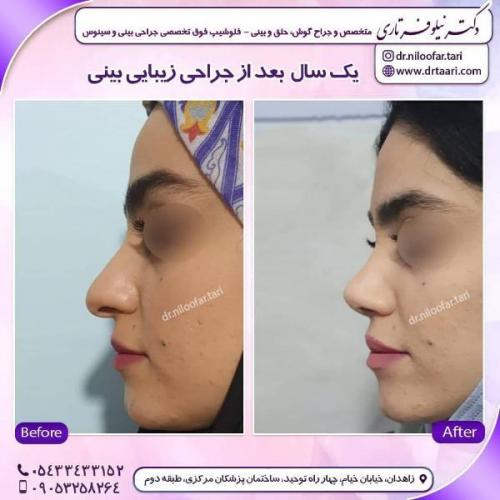جراحی بینی 285 (29)