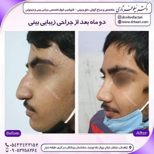 جراحی بینی 285 (3)
