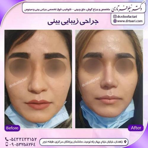 جراحی بینی 285 (30)