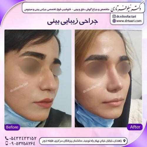 جراحی بینی 285 (31)