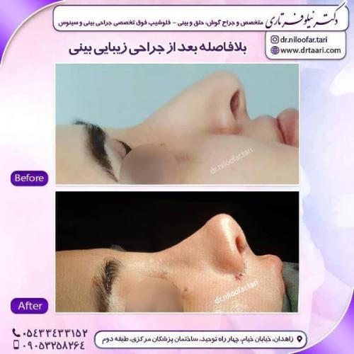 جراحی بینی 285 (36)