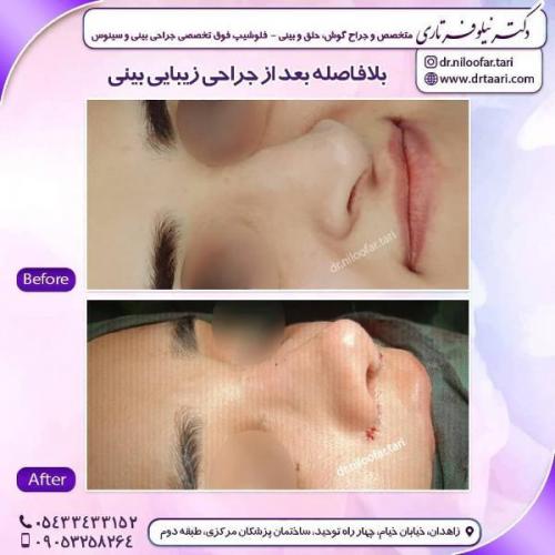 جراحی بینی 285 (37)