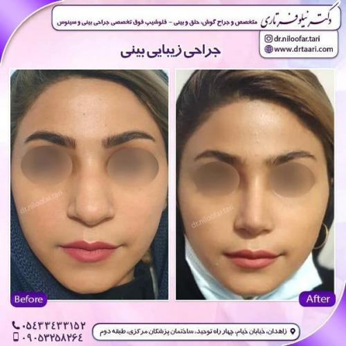 جراحی بینی 285 (38)