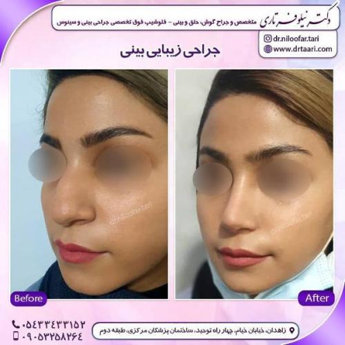جراحی بینی 285 (39)
