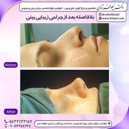 جراحی بینی 285 (4)