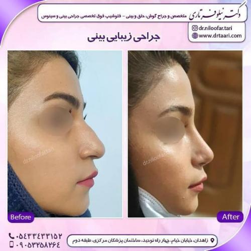 جراحی بینی 285 (41)